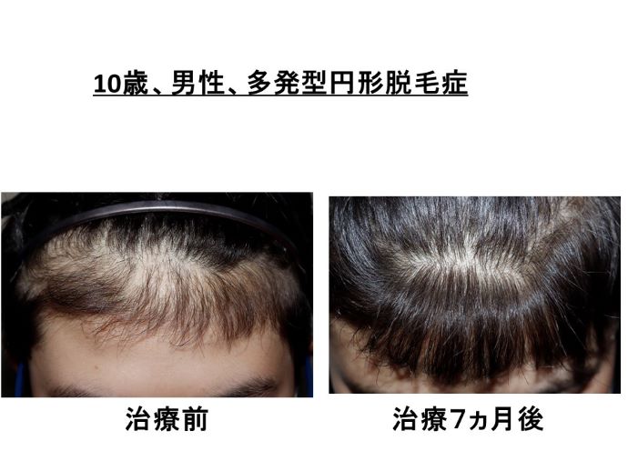 円形脱毛症　病院
